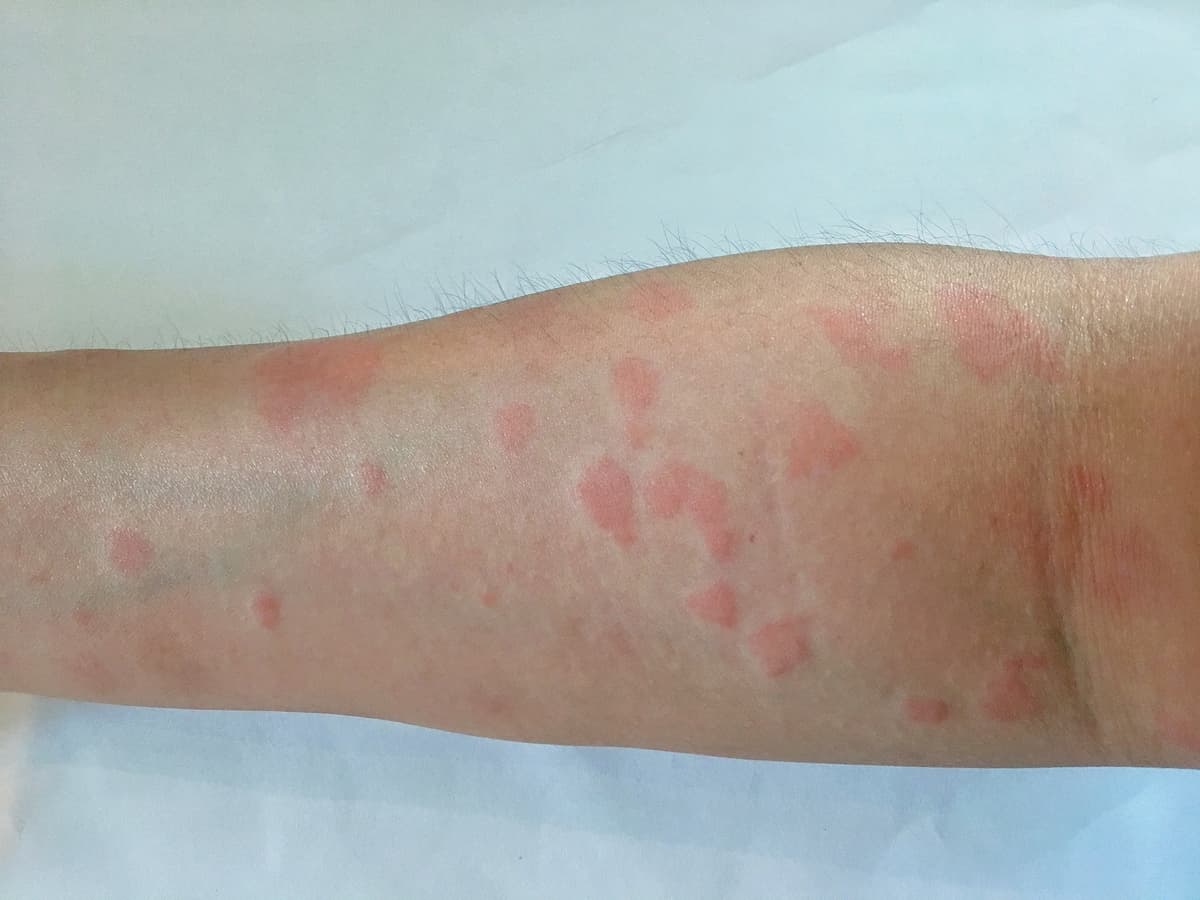 Kelebek Hastalığı (Lupus) nedir, belirtileri nelerdir?